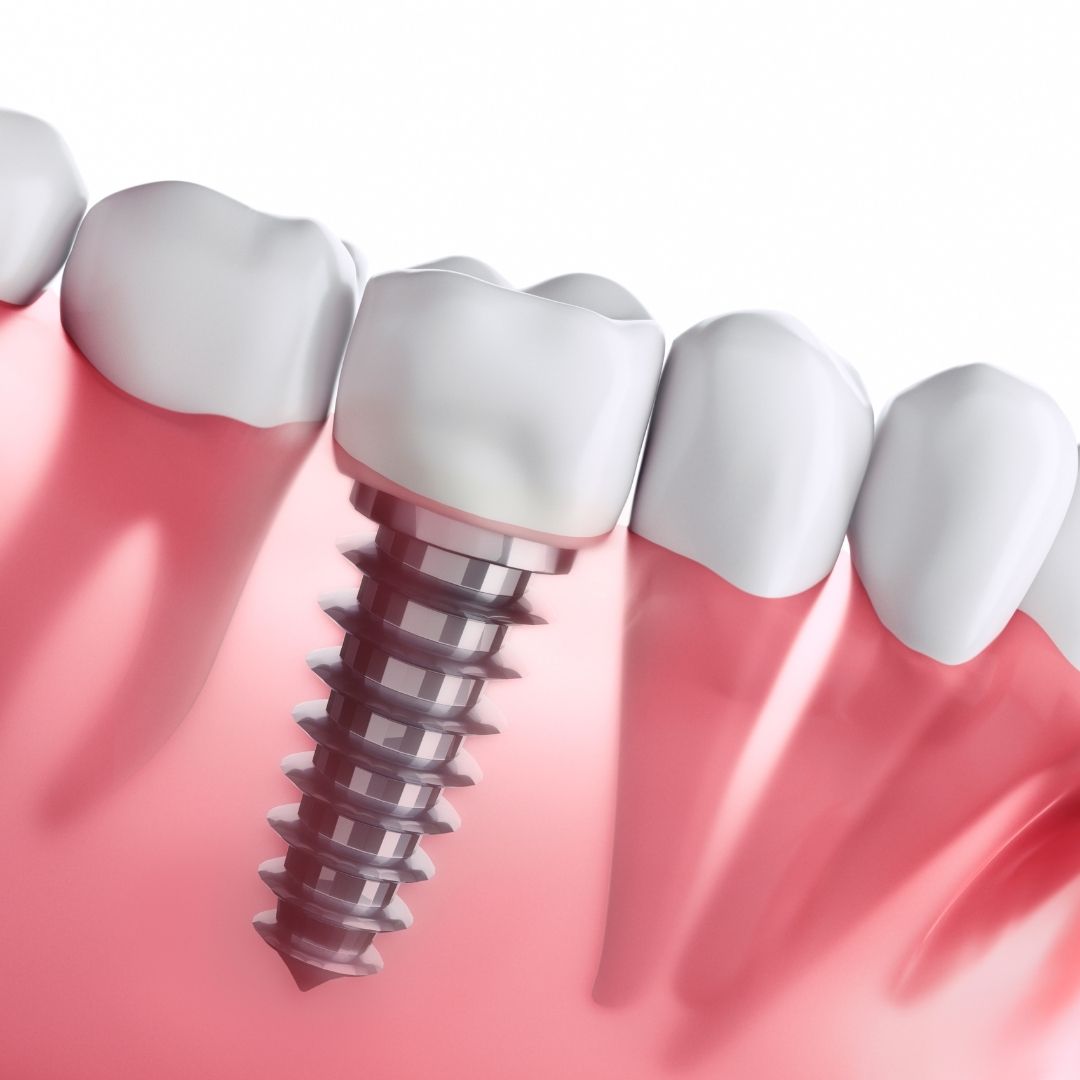 dental implants