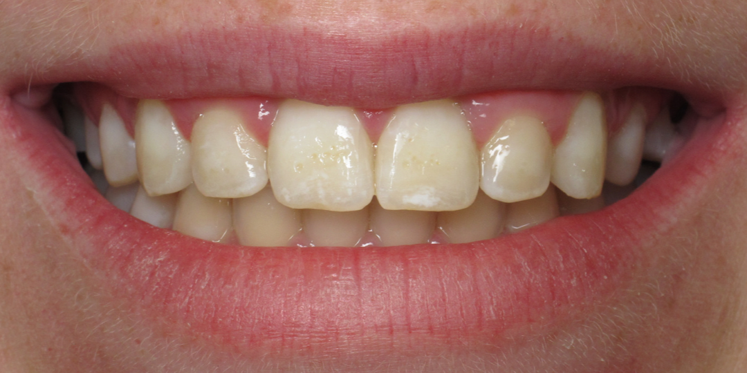 Tooth Colored Fillings