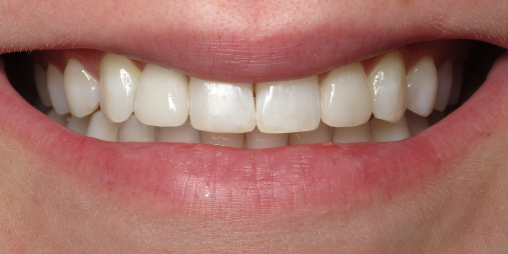 veneers and crowns after