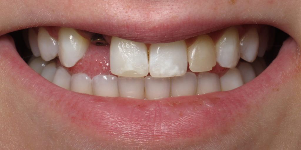 veneers and crowns before