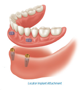 removable denture implant