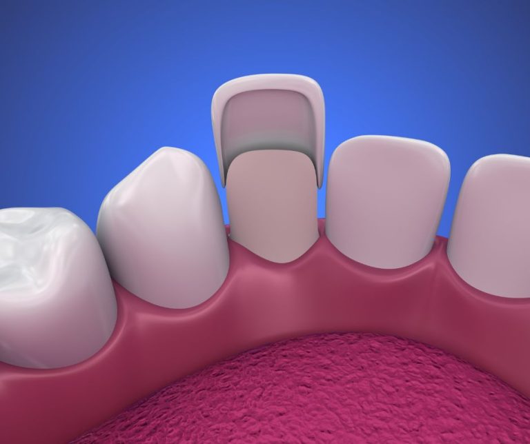 Dental Veneers Idaho Falls Dixon Dental Center